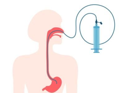 Feeding Tubes