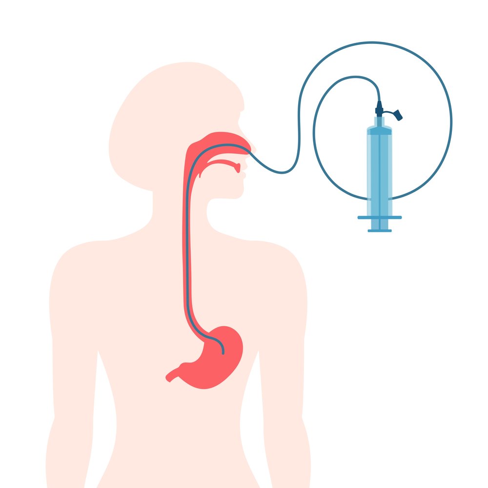 Nasogastric,Tube,Passed,Through,The,Nose,To,Stomach.,Ng,With
